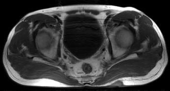 Figure 2 for case Hidradenitis suppurativa